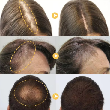 Capilux™ - Disaar Anti Caida Cabello